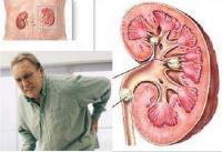 چه غذاهایی باعث ایجاد سنگ کلیه می شود؟ 